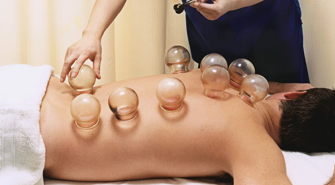 cupping therapy Denver